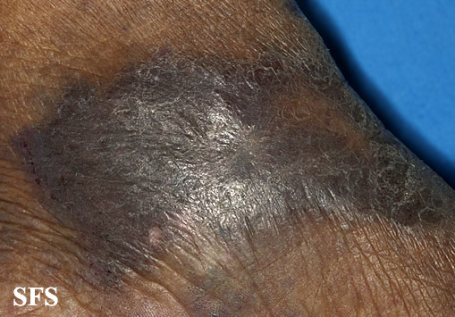 Acroangiodermatitis. Adapted from [http://www.atlasdermatologico.com.br/disease.jsf?diseaseId=9