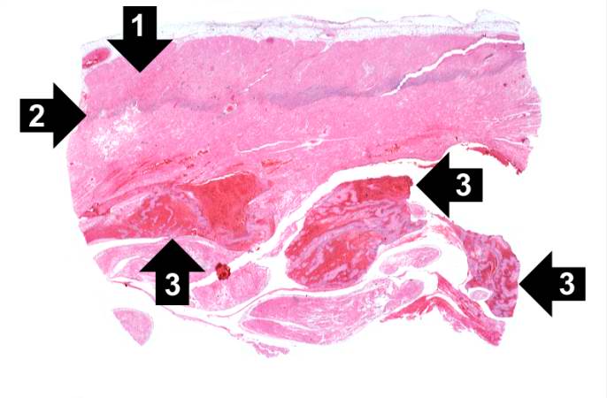 This is a low-power photomicrograph of infarcted heart. There is a layer of surviving myocardial tissue (1) along the epicardium and then a blue line (2) which represents the accumulation of inflammatory cells at the border of the infarct. There is thrombotic material (3) adherent to the endocardial surface.