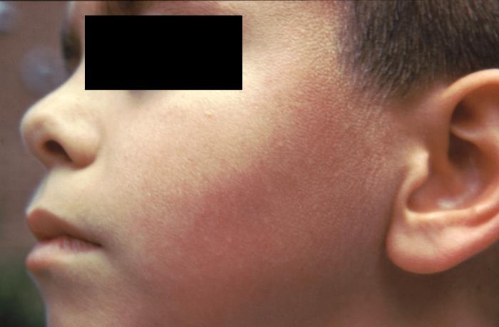 Note the left side of this boy’s face displaying signs of erythema infectiosum, or Fifth disease. From Public Health Image Library (PHIL). [2]