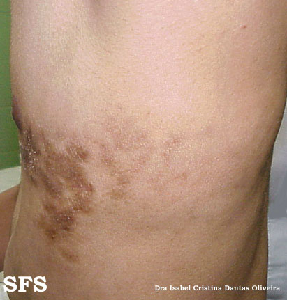 Linear scleroderma. Adapted from Dermatology Atlas.[12]