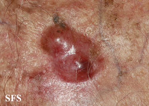 url = http://www.atlasdermatologico.com.br/disease.jsf?diseaseId=288>