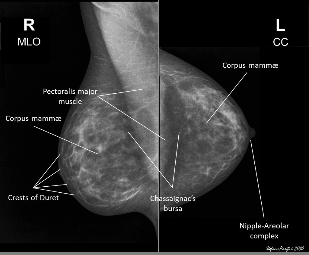 File:Normal mammograms.jpg
