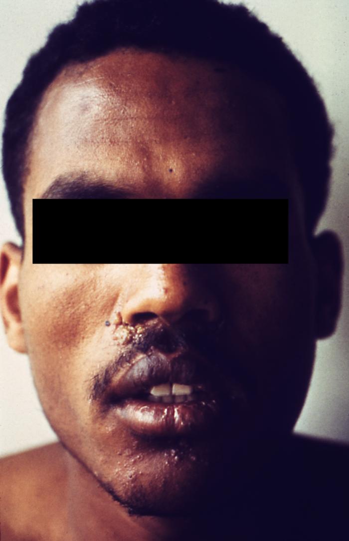 This patient presented with a primary syphilitic chancre of the lip. The primary stage of syphilis is usually marked by the appearance of a sore called a chancre. The chancre is usually firm, round, small, and painless. It appears at the spot where syphilis entered the body, and lasts 3-6 weeks, healing on its own. Adapted from CDC