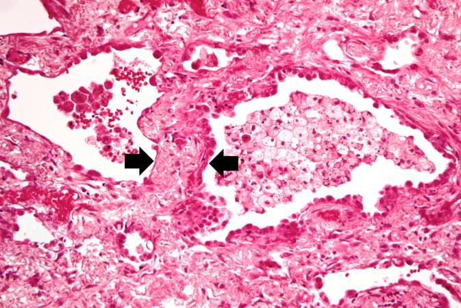 This high-power photomicrograph of lung section shows the thickening of the alveolar septum (arrows) by fibrous connective tissue.