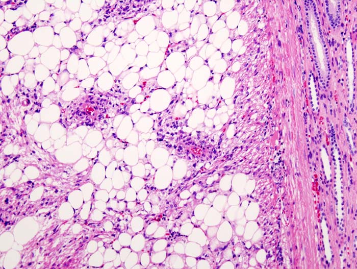 Histopathologic image of renal angiomyolipoma. Nephrectomy specimen. H & E stain.[2]
