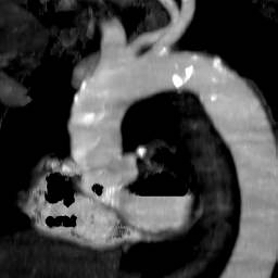File:Renal artery stenosis 034.jpg
