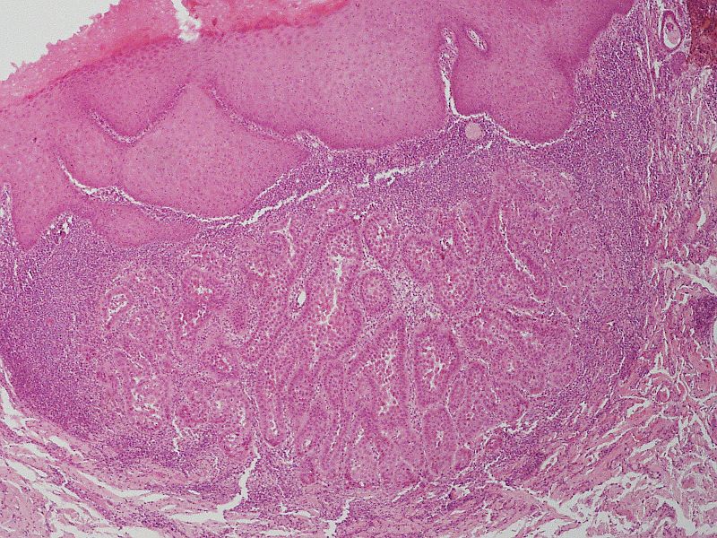HPE of warty dyskeratoma showing keratotic plug