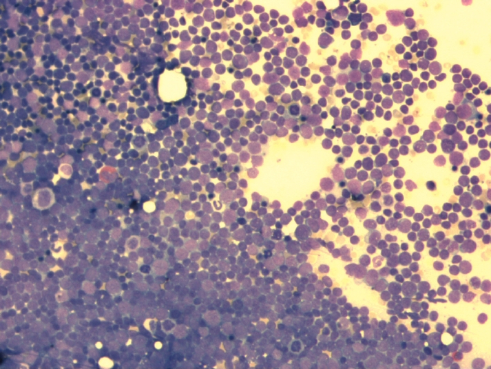 bone marrow smear from a patient with acute lymphoblastic leukemia