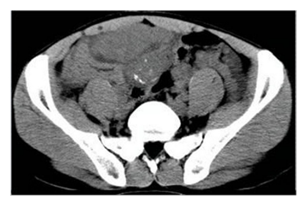 Abdominopelvic CT scan revealed diffuse multiple soft-tissue masses in peritoneal and mesenteric surfaces.[12]