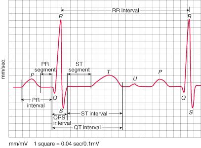 EKG wave morphology.jpg