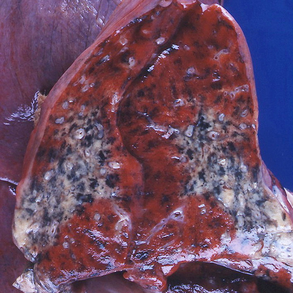 Granulomatosis with polyangiitis-Case courtesy of Dr. Yale Rosen[12]