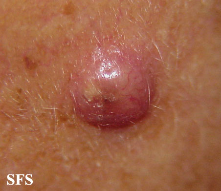 File:Squamous cell carcinoma 28.jpeg