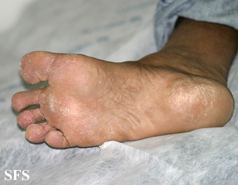 Athlete's foot - Tinea pedis - DocCheck