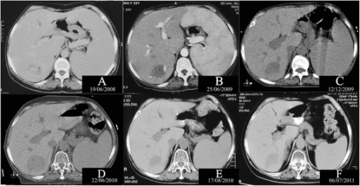 File:Ct splenomegaly gif.gif