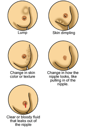 Illustration of the early warning signs of breast cancer