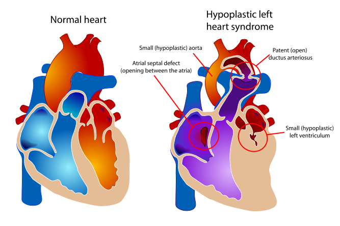 Hypoplastic left heart syndrome.svg