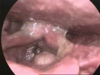 Endoscopic view of laryngeal cancer