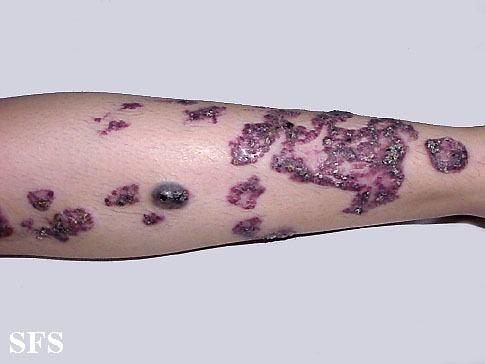 Angiokeratoma Circumscriptum. Adapted from Dermatology Atlas.<ref name="Dermatology Atlas">{{Cite