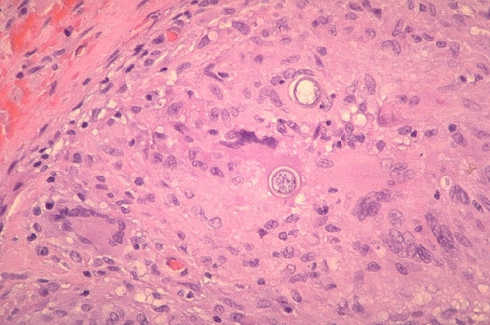 Histopathology of coccidioidomycosis, retroperitoneal area. From Public Health Image Library (PHIL). [1]