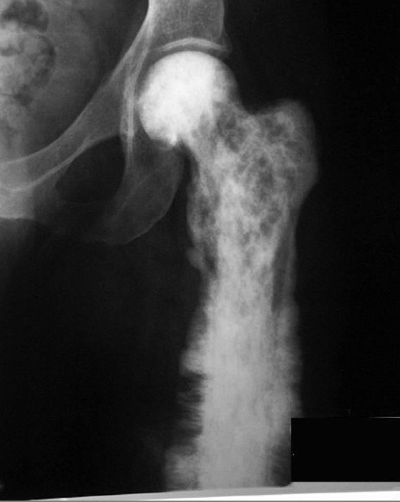 File:Osteosarcoma-in-paget-disease.jpg