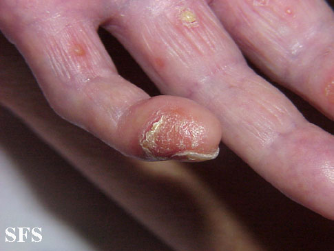 Reiter's syndrome. Adapted from Dermatology Atlas.[2]