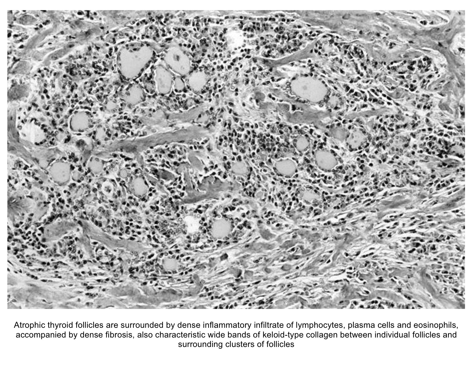 Histology of Riedel's thyroiditis (Image courtesy of AFIP and PathologyOutlines.com; http://www.pathologyoutlines.com/topic/thyroidriedel.html )