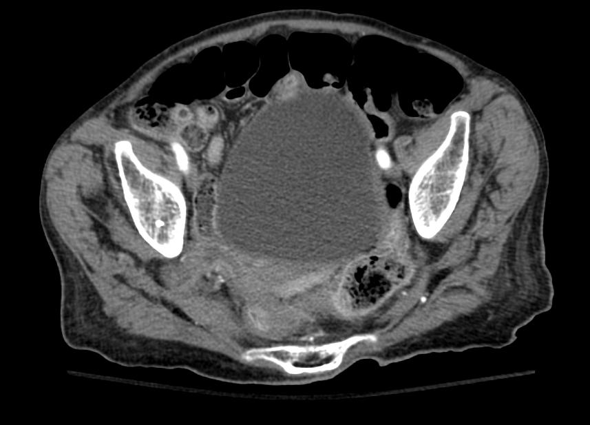 File:Sciatic hernia CT 001.jpg