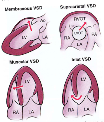 File:VSD types and blood flow.png