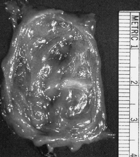 Lower Respiratory Tract: Bronchogenic cysts are grossly nondescript, usually unilocular cavities containing mucus or mucopurulent material with a wall that varies in thickness and may contain cartilage.