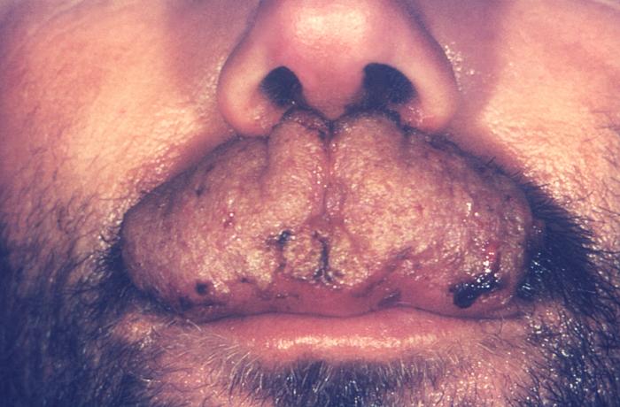 Close view of the lips and nose of a male patient infected with the dermatophytic fungus, Trichophyton mentagrophytes. From Public Health Image Library (PHIL). [1]
