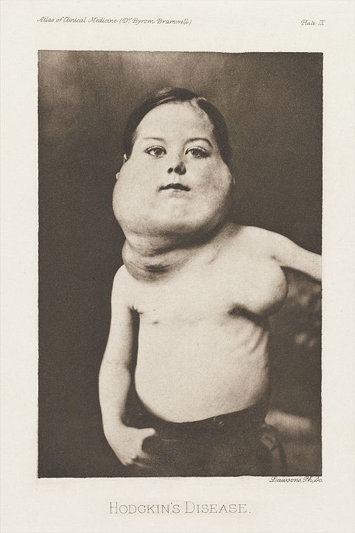File:Child with Hodgkin's lymphoma.jpeg