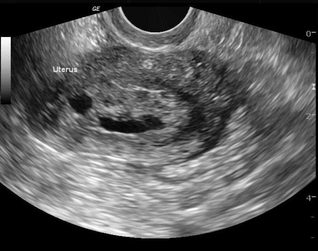 Endometrial hyperplasia[4]