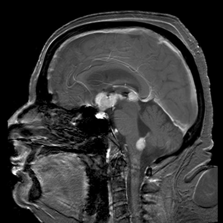 Brain magnetic resonance imaging demonstrating primary central nervous system B-cell non-Hodgkin lymphoma of the sella turcica and hypothalamus, continuing to the tectum (intensely white areas in the middle).[3]