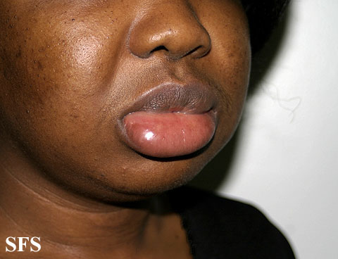 Angioedema. Adapted from Dermatology Atlas.[8]