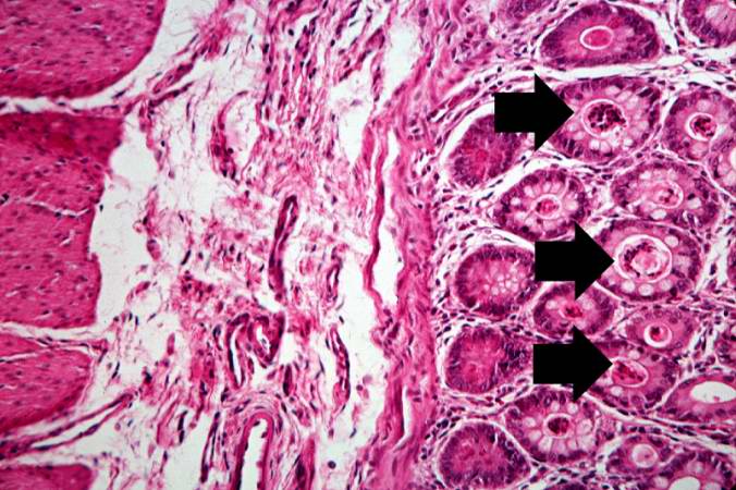 This is a higher-power photomicrograph showing the eosinophilic debris in many of the intestinal crypts (arrows).