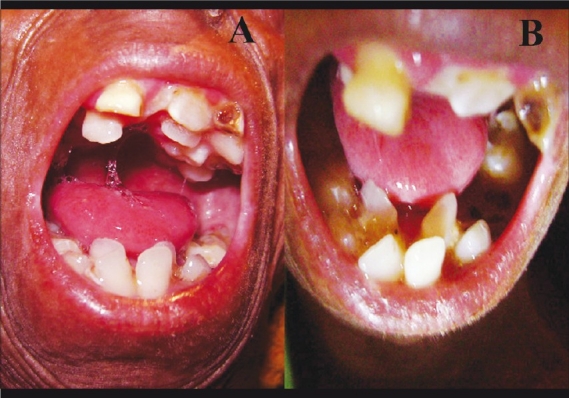 File:Dental crowding and dental caries.jpg