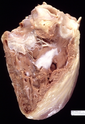Left ventricular endocardial fibrosis due to implantable defibrillator