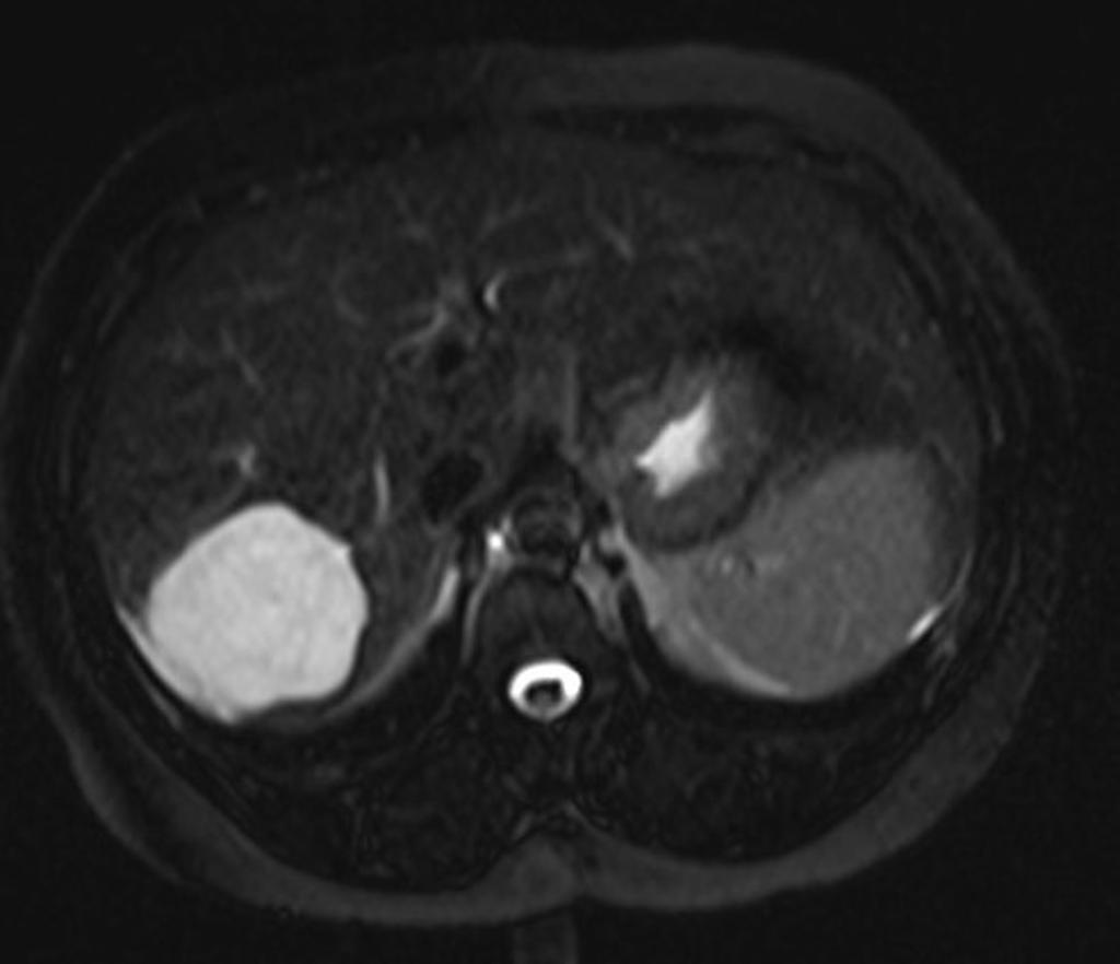 MRI demonstrates a lobulated T2 hyperintense lesion in the right lobe segments VI and VII.[2]