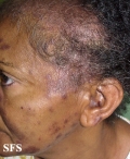 Lupus Erythematosus-Subacute Cutaneous Lupus Erythematosus. Adapted from Dermatology Atlas.[4]