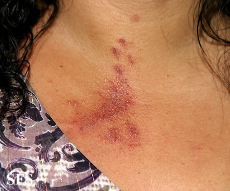 Paederus dermatitis. Adapted from Dermatology Atlas.[9]