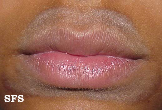 Perioral dermatitis. With permission from Dermatology Atlas.[1]
