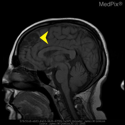 File:Sagggital MRI TRI.jpg