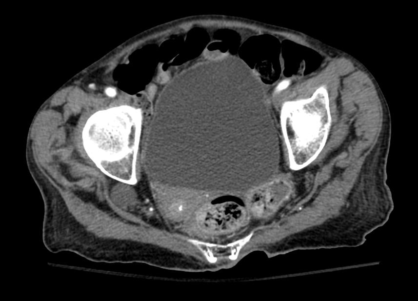 File:Sciatic hernia CT 003.jpg