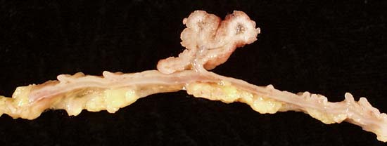 Adenomatous polyp of colon: Longitudinal section of the same polyp