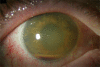 Anterior chamber inflammation, mild corneal edema, and hypopyon in bacterial endophthalmitis