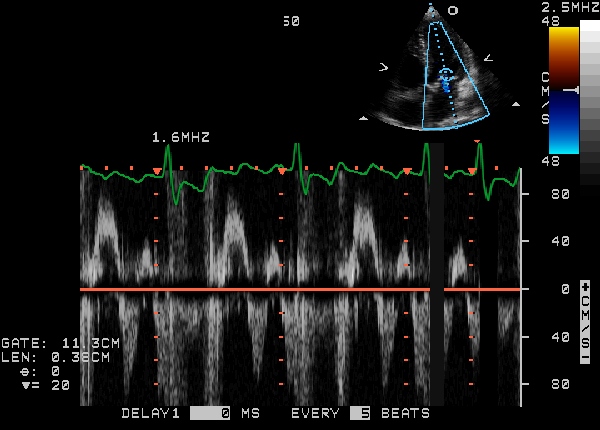 Mitral regurgitation echocardiography - wikidoc