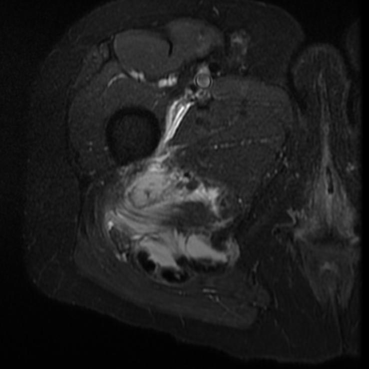 File:Hamstring tendon avulsion MRI 007.jpg