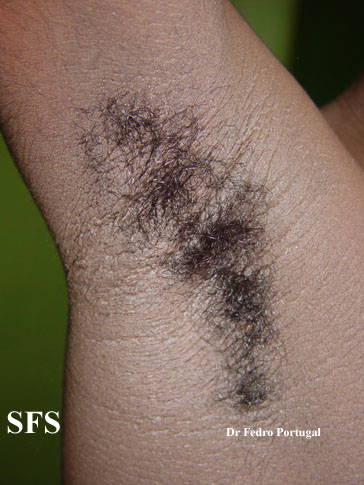 Acanthosis nigricans benign. Adapted from Dermatology Atlas.[2]