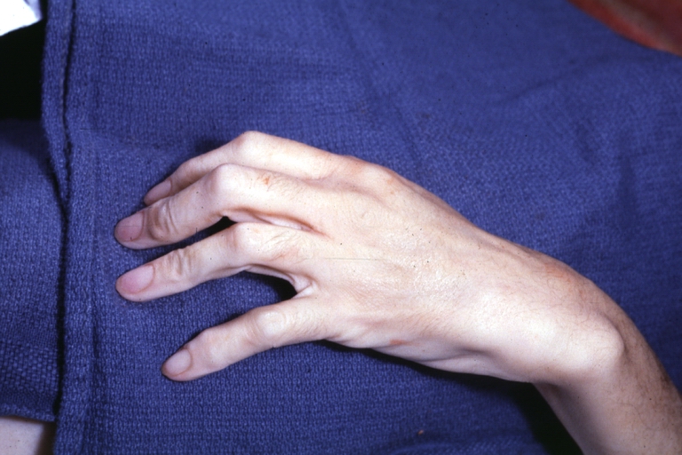 Arachnodactyly: Gross, natural color, long fingers