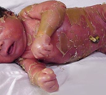 Collodin baby. Adapted from Dermatology Atlas.[1]